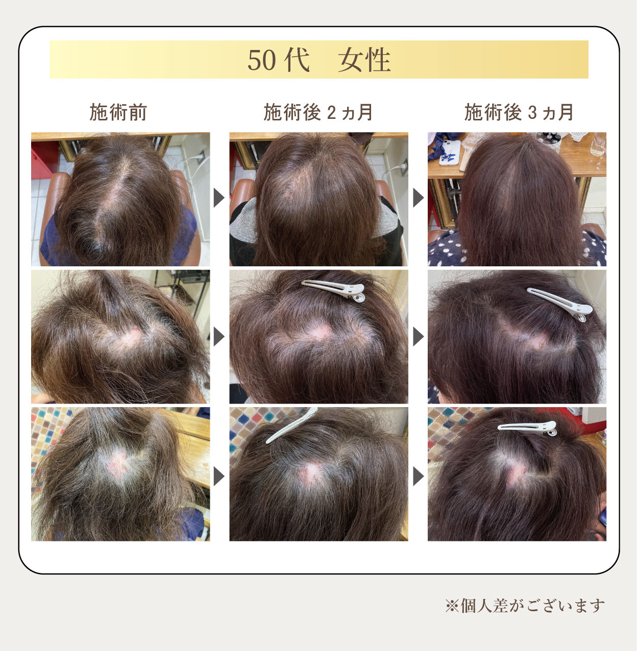 50代女性、施術前、施術後2ヵ月、施術後3ヵ月、※個人差がございます。